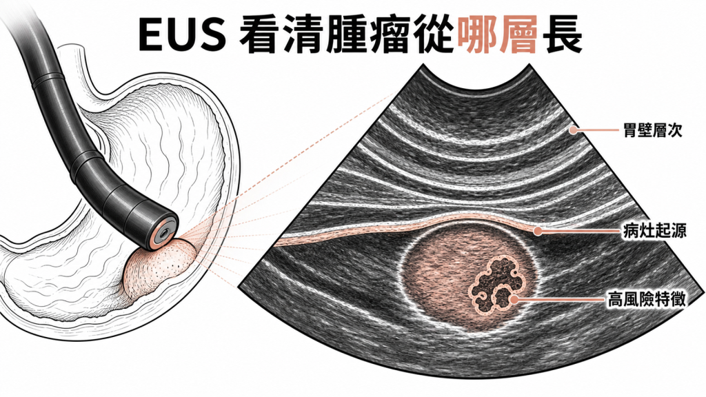 超音波內視鏡可看清黏膜下腫瘤的胃壁層次與起源