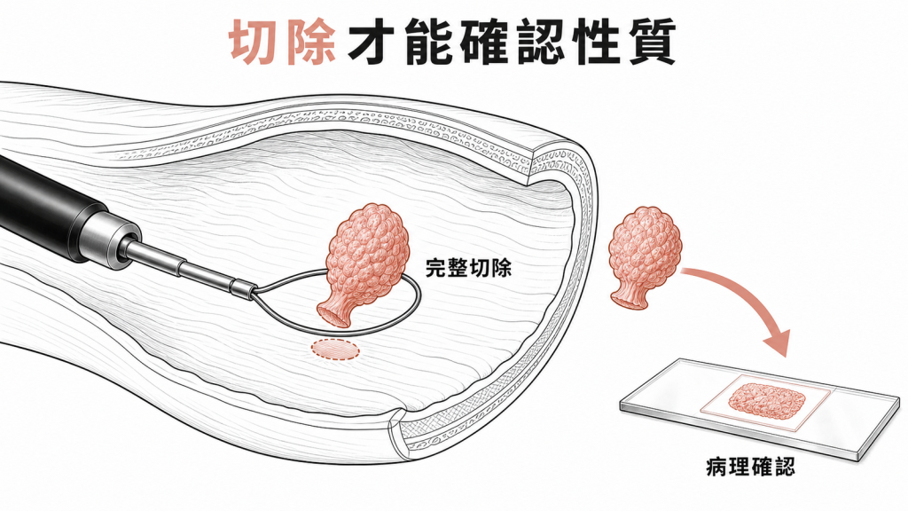 內視鏡完整切除並送病理確認