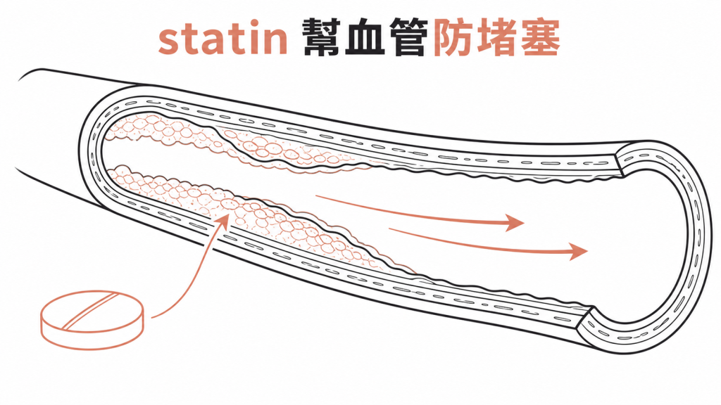 血管剖面示意圖:statin 降低壞膽固醇、幫血管清除沉積、防止堵塞