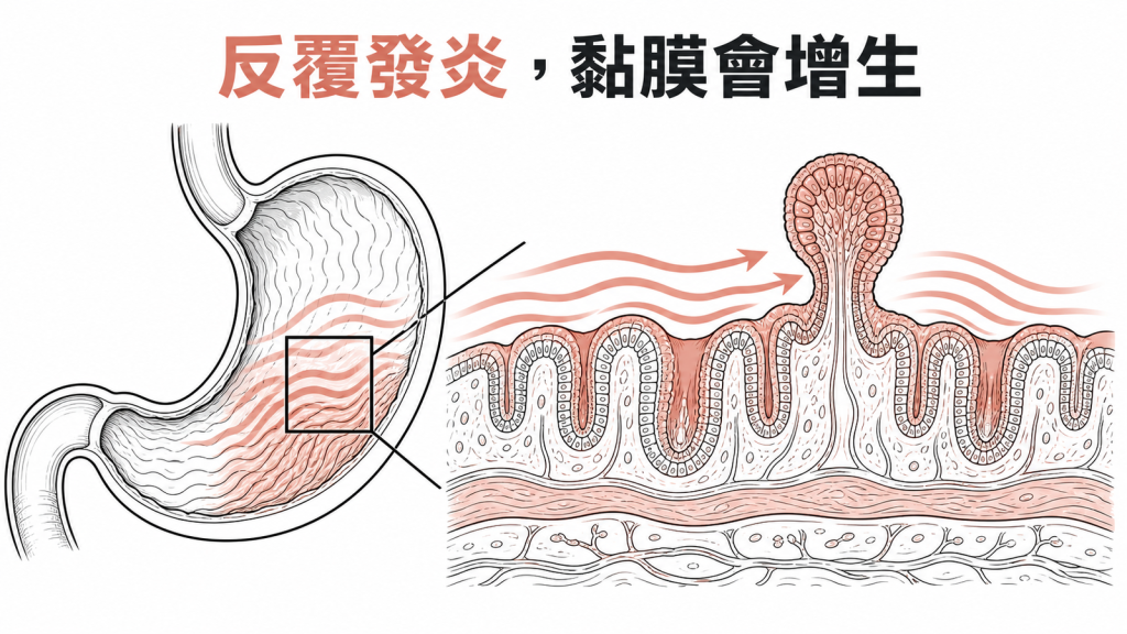 胃黏膜慢性發炎與增生性息肉線稿示意圖