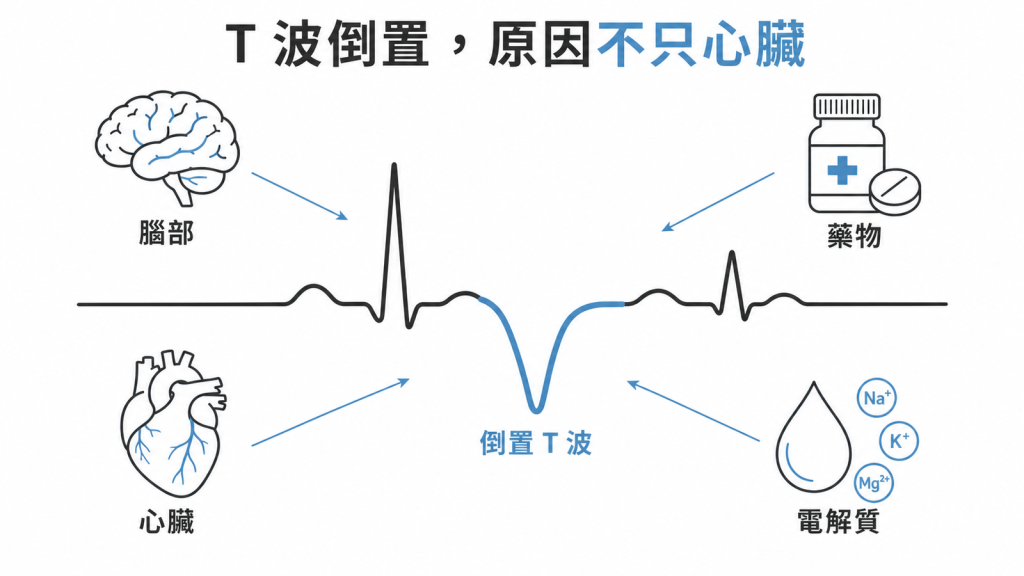 T波倒置成因示意圖:心臟本身、腦部事件、藥物與電解質異常都可能造成同樣的倒置波形