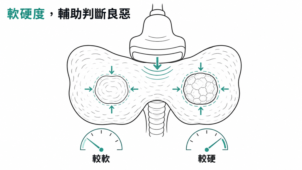 彈性超音波量結節軟硬度輔助判斷良惡的示意圖