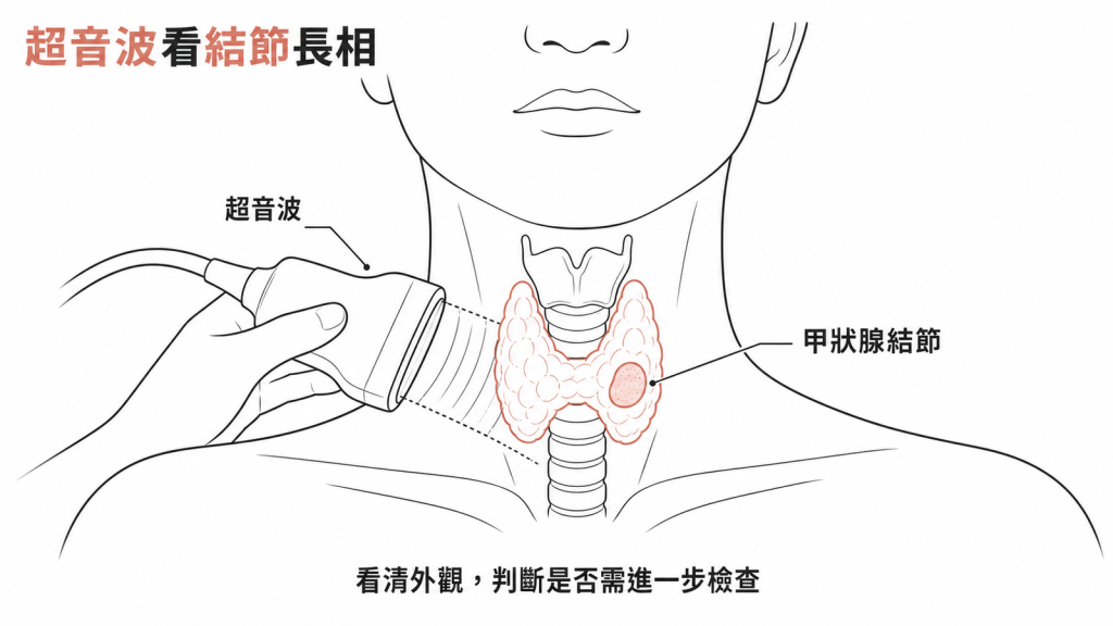 超音波隔著皮膚看甲狀腺結節的邊界、內容與鈣化,判斷是否需要進一步檢查