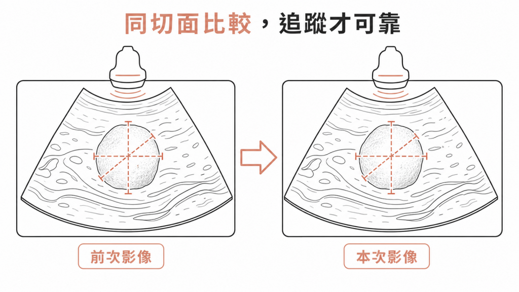 甲狀腺超音波前後同切面三向量測比較示意圖