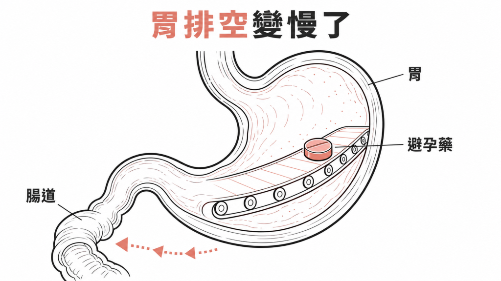 猛健樂延緩胃排空影響口服避孕藥吸收