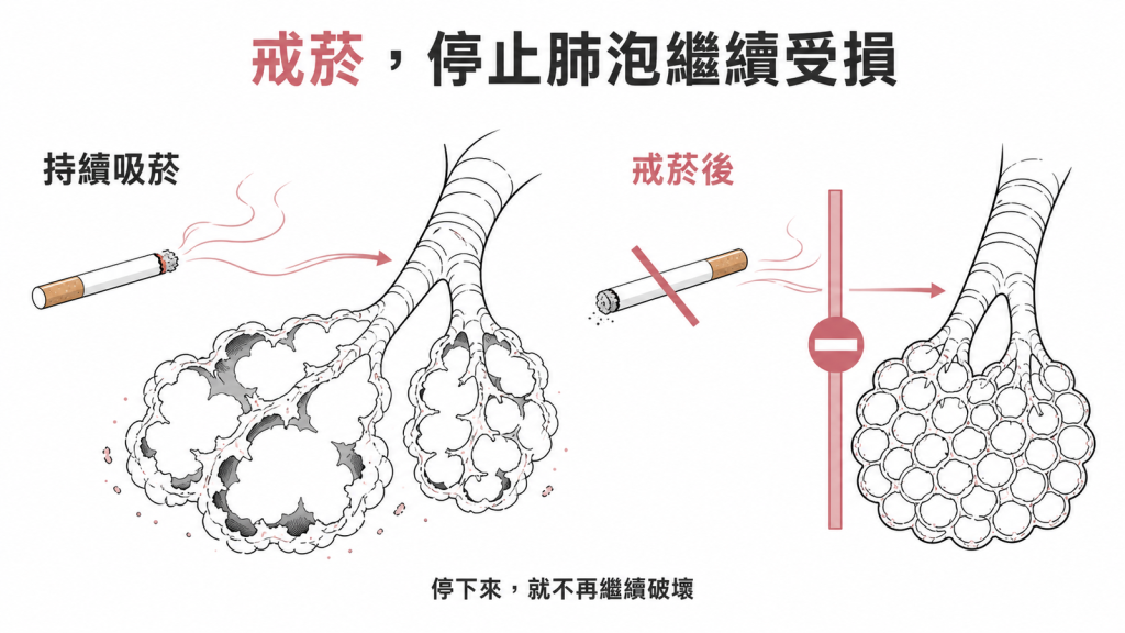 戒菸可以停止肺泡繼續被破壞