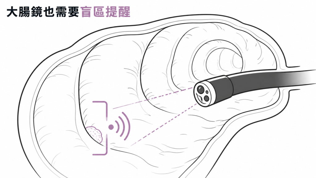 大腸皺褶後方的盲區容易漏看，AI 會即時提醒