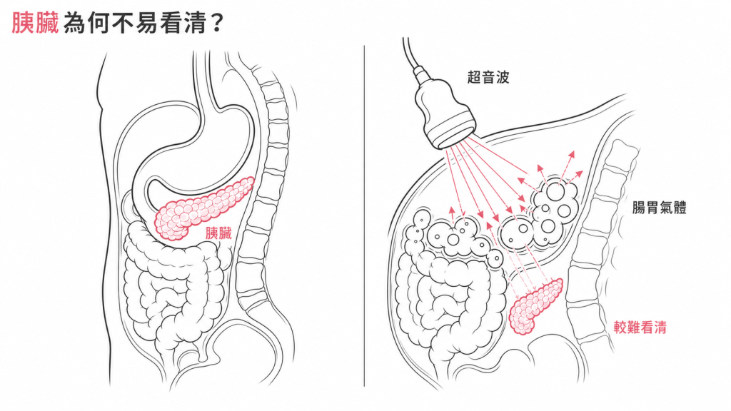 胰臟位置隱密貼著脊椎,超音波訊號容易被腸胃空氣擋住