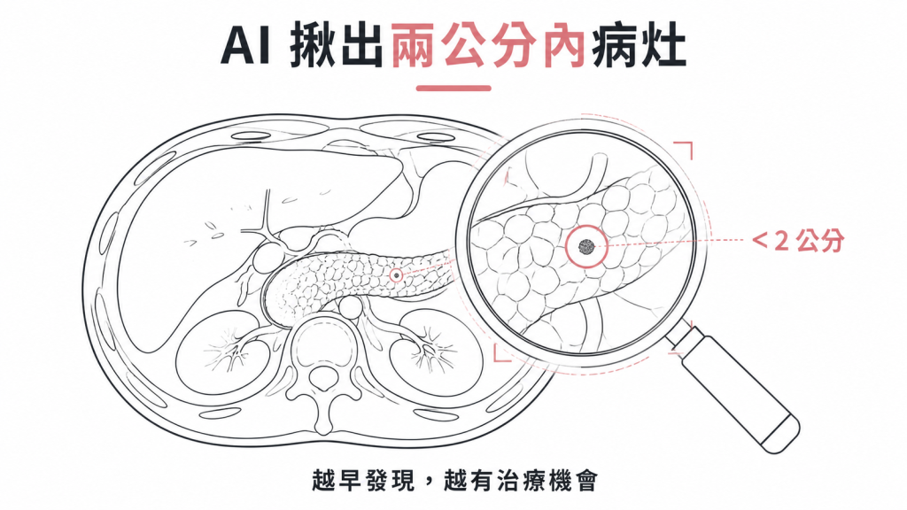 AI 協助在電腦斷層上揪出小於兩公分的胰臟病灶