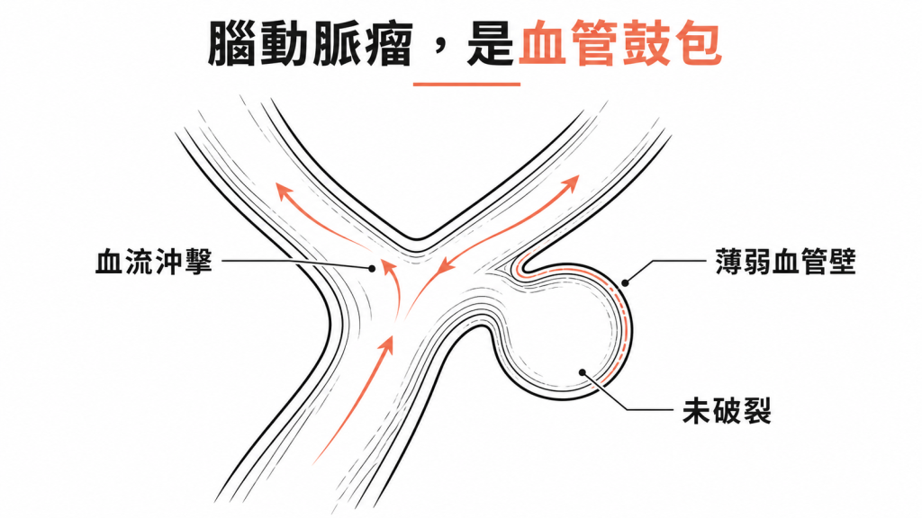 腦動脈瘤示意圖：血管分岔處被血流沖擊撐出的鼓包，管壁薄弱但尚未破裂