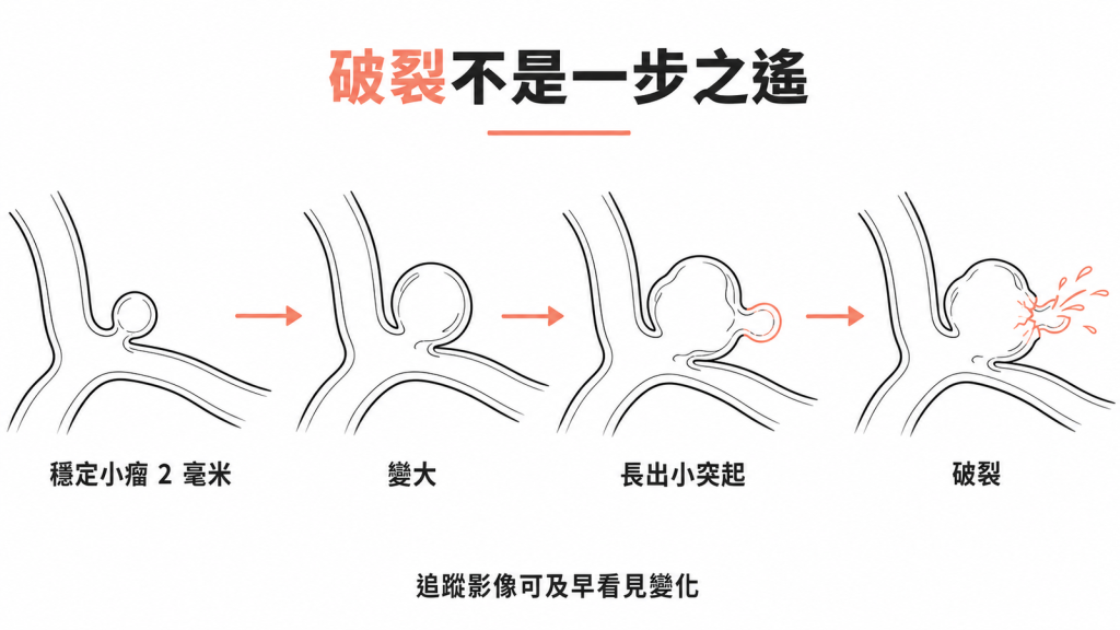 未破裂腦動脈瘤走向破裂的過程：從穩定小瘤變大、長出小突起，才可能破裂，追蹤影像能及早看見變化