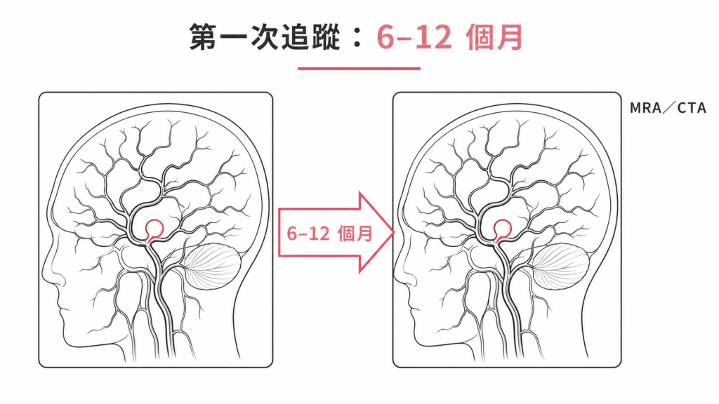 腦動脈瘤追蹤時程示意圖：發現後 6 到 12 個月安排第一次 MRA 或 CTA 追蹤影像