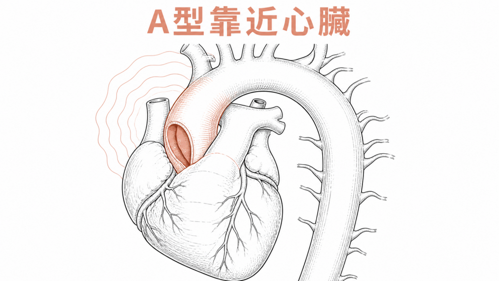 A 型主動脈剝離位於靠近心臟的升主動脈圖解