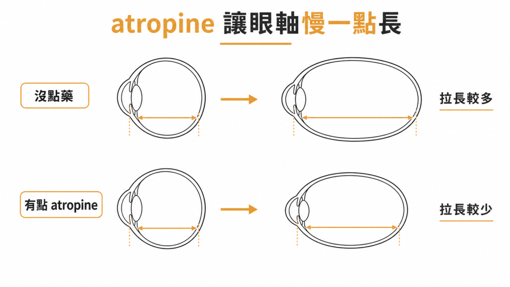 有點 atropine 與沒點藥的眼軸拉長對照圖,眼球都會變長,差別在拉長多少