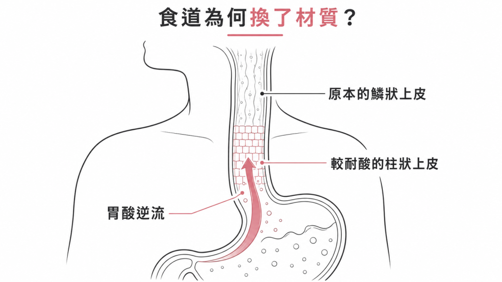 胃酸長期逆流讓食道下段的鱗狀上皮換成較耐酸的柱狀上皮示意圖