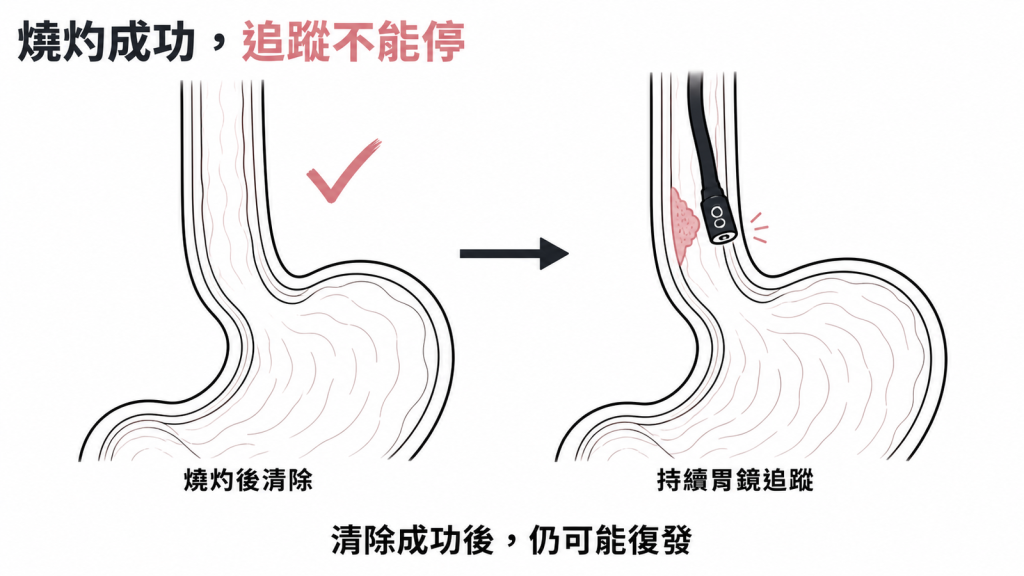 燒灼清除成功後仍可能復發、需持續胃鏡追蹤示意圖