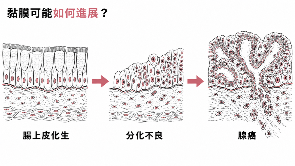 腸上皮化生、分化不良到腺癌的黏膜進展路徑示意圖