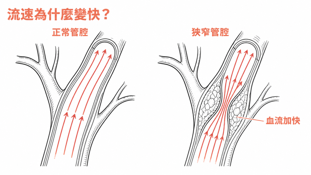 頸動脈管腔狹窄時血流速度加快示意圖