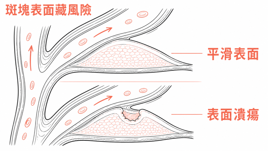 頸動脈斑塊表面平滑與潰瘍破損比較圖