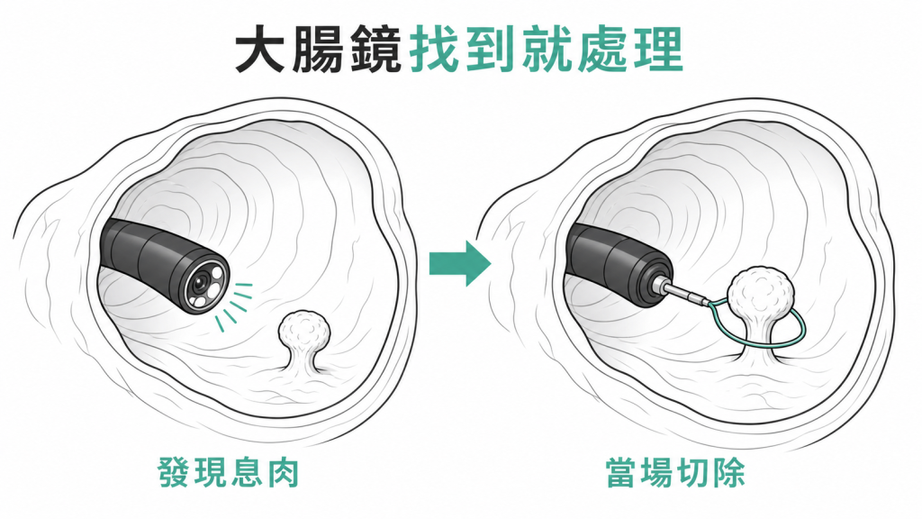 大腸鏡發現息肉後當場切除的示意圖