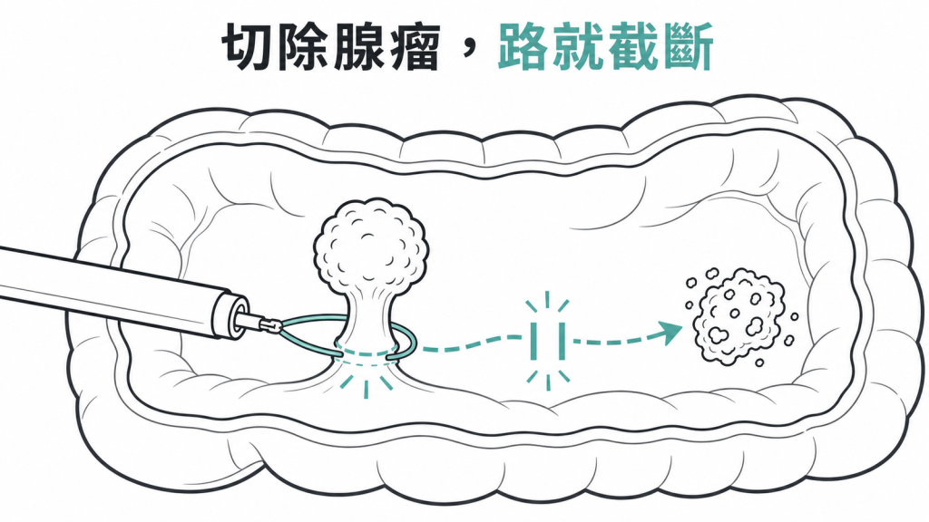 從大腸息肉走到大腸癌需要很多年的示意圖