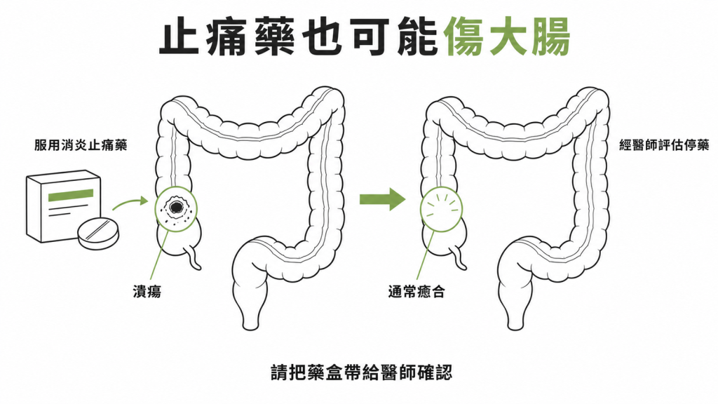 消炎止痛藥造成右側大腸潰瘍、停藥後多能癒合的示意圖