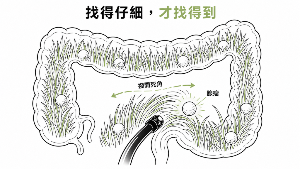 把大腸比喻成長草區,腺瘤像藏在草叢裡的球,內視鏡撥開皺褶死角才找得到