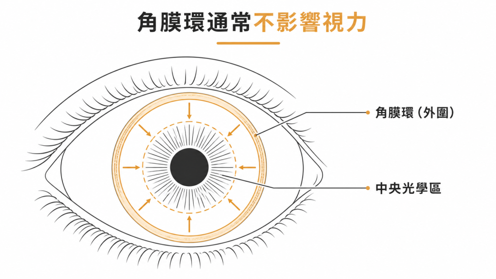 角膜環位於角膜外圍,不會蓋住中央光學區,通常不影響視力