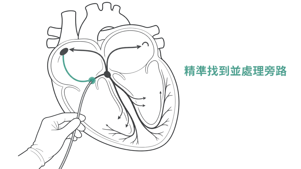 導管消融精準找到並處理心臟旁路的示意圖