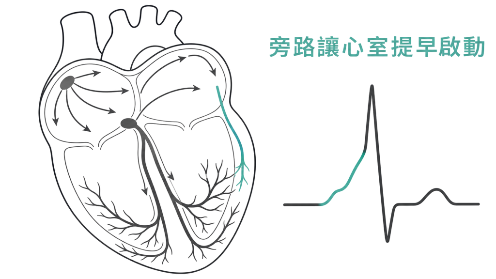 旁路讓心室提早啟動並形成 Delta wave 的示意圖