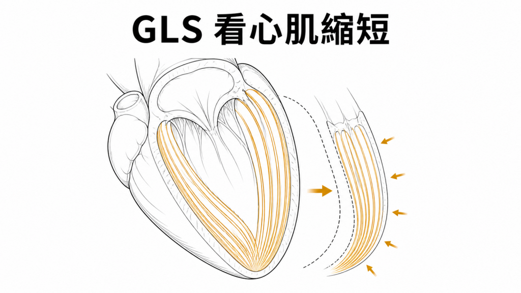 左心室心肌縱向纖維縮短的 GLS 示意圖