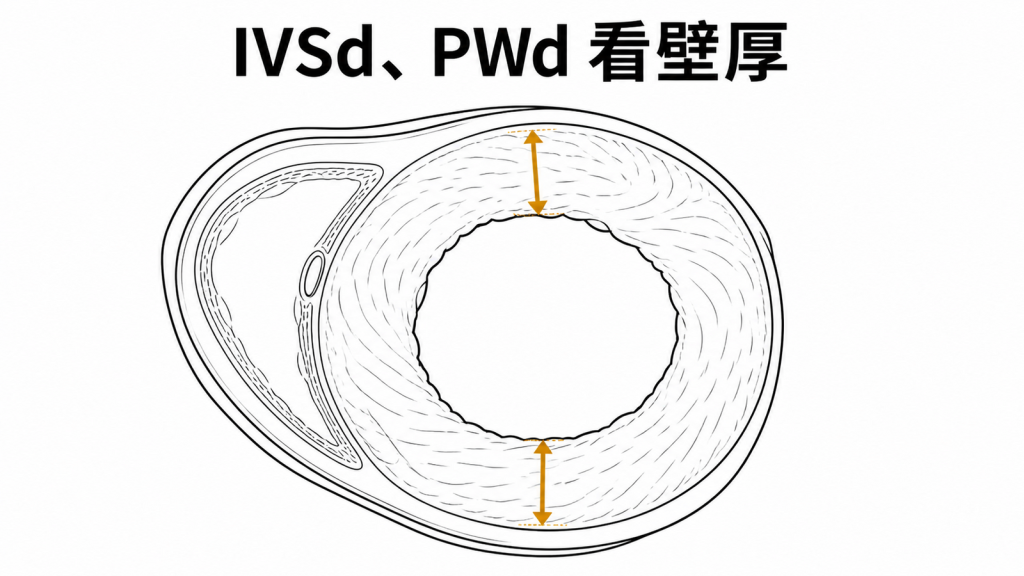 心室中隔與左心室後壁厚度量測示意圖