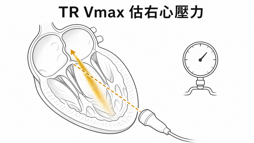 三尖瓣逆流速度估計右心室壓力示意圖