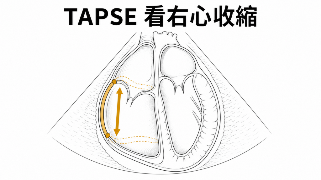 TAPSE 評估右心室縱向收縮示意圖