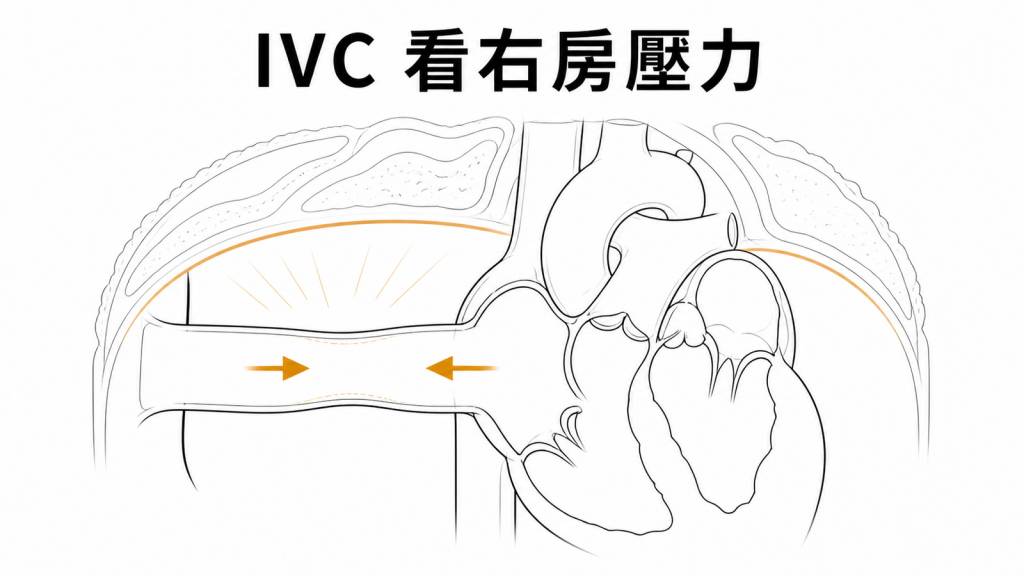 下腔靜脈直徑與吸氣塌陷示意圖