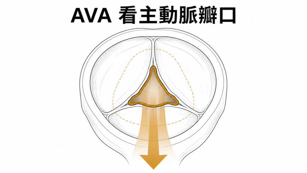 主動脈瓣有效開口面積與狹窄血流示意圖