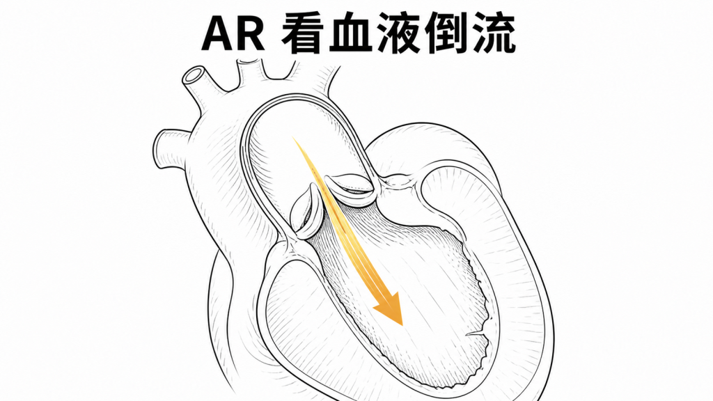 主動脈瓣逆流回左心室示意圖