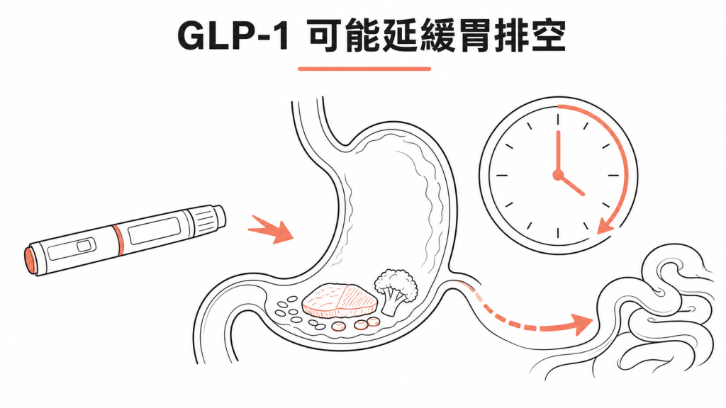 GLP-1 藥物可能延緩胃排空示意圖