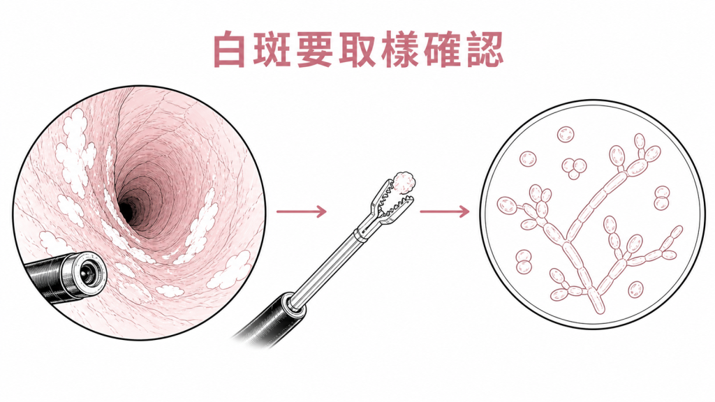 胃鏡看到食道白斑後取樣確認念珠菌示意圖