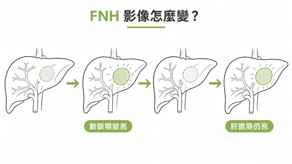 FNH 從動脈期增亮到肝膽期保留顯影的磁振造影變化