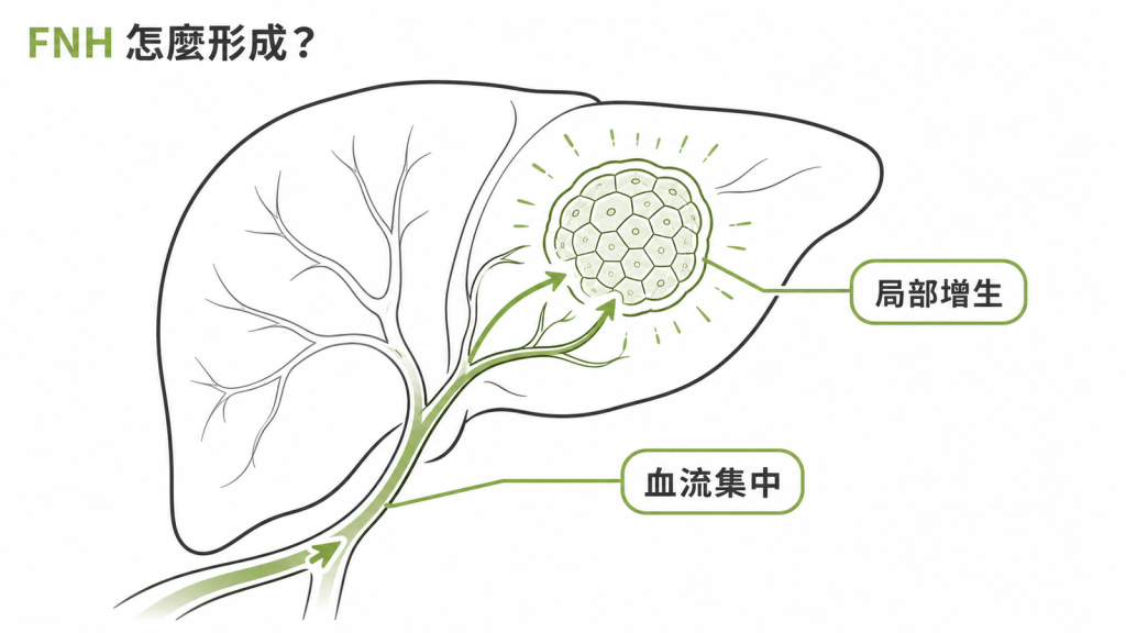 局部血流集中使肝細胞形成 FNH 良性結節