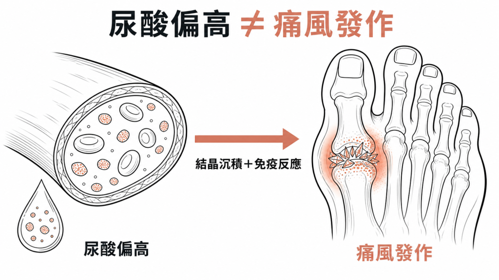 尿酸偏高不等於痛風：要先有尿酸鹽結晶沉積在關節並引發免疫反應，才會急性發作