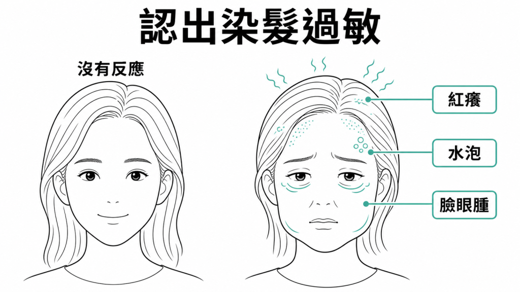染髮過敏可能出現頭皮紅癢、水泡與臉眼腫脹