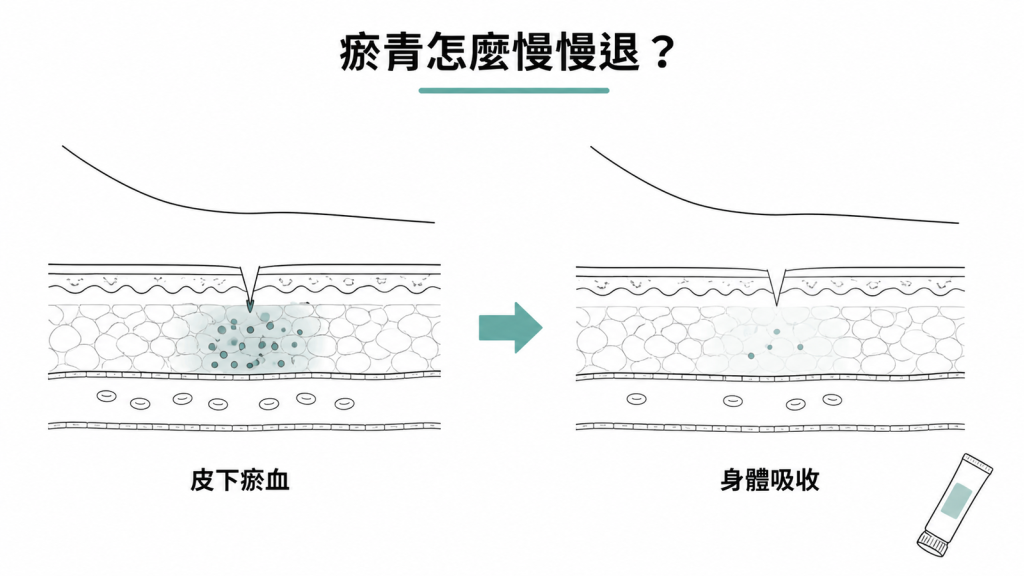 抽血後皮下瘀血由身體逐步吸收並自然變淡示意圖