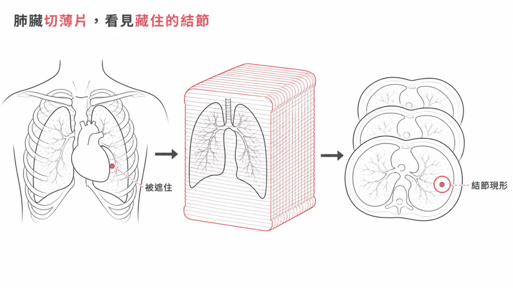低劑量電腦斷層把肺臟切成薄片,看見胸部X光被心臟遮住的小結節