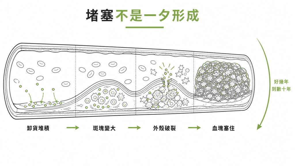 從 Lp(a) 偏高走到心肌梗塞的四個步驟:卸貨堆積、斑塊變大、外殼破裂、血塊塞住,需要好幾年到數十年