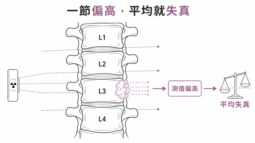 腰椎鈣化讓某節測值偏高、拉高平均值的示意圖