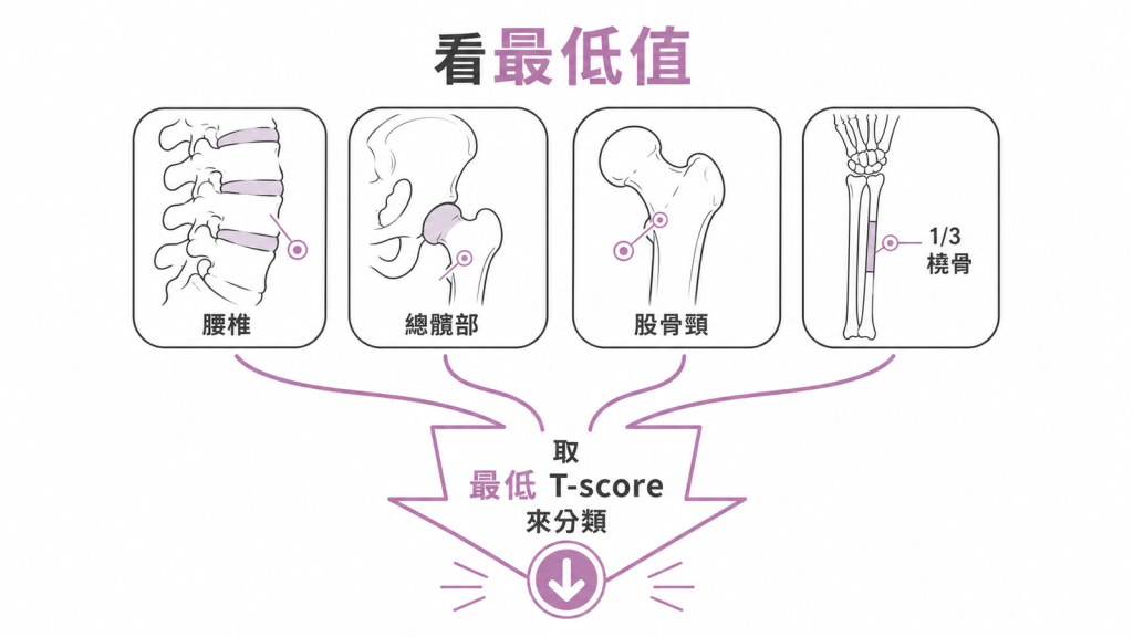 骨密度診斷看腰椎、總髖部、股骨頸與合格橈骨中的最低 T-score