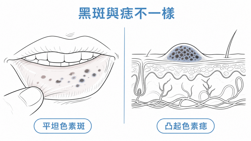 嘴唇平坦色素斑與皮膚凸起色素痣的外形差別