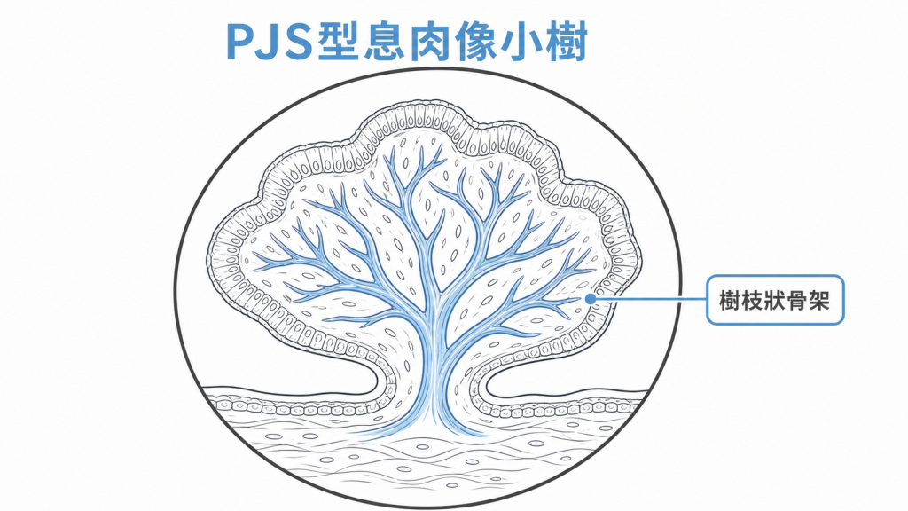 PJS 型息肉在顯微鏡下呈現樹枝狀平滑肌骨架